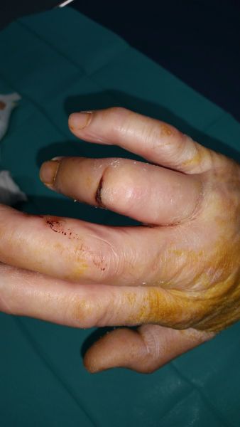 Sår efter operation i hånd