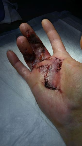 2017-04-02-1113_Sår efter operation i hånd_-