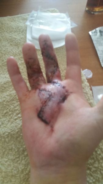 2017-04-04-0957_Sår efter operation i hånd_-