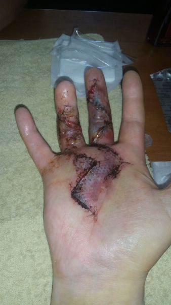 2017-04-04-0957_Sår efter operation i hånd_-_2
