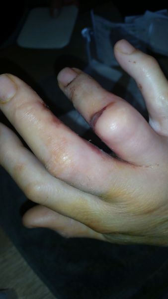 2017-04-05-1110_Sår efter operation i hånd_-_2