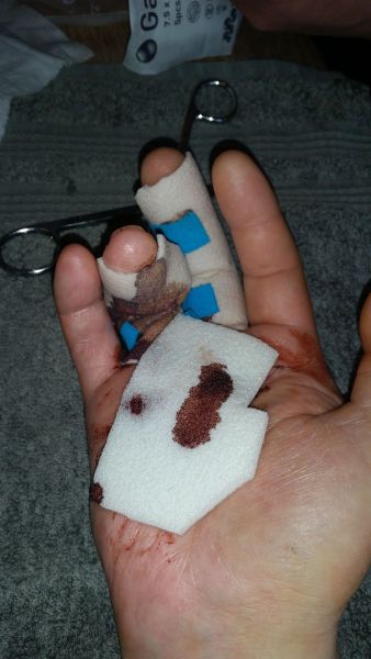 2017-04-06-1737_Sår efter operation i hånd_-