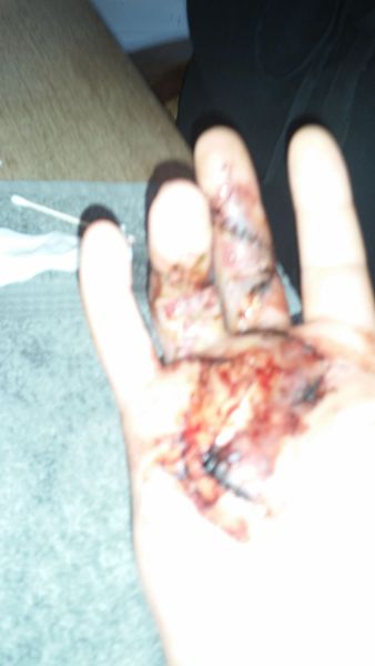 2017-04-06-1739_Sår efter operation i hånd_-