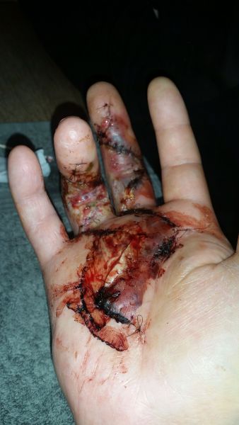 2017-04-06-1739_Sår efter operation i hånd_-_2