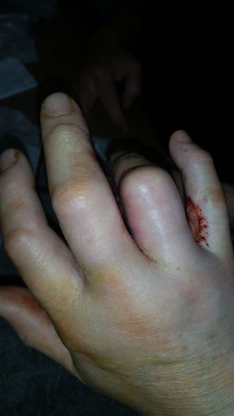 2017-04-06-1739_Sår efter operation i hånd_-_3