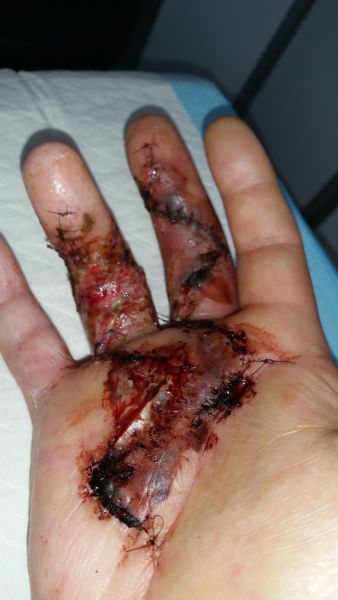 2017-04-07-1341_Sår efter operation i hånd_-