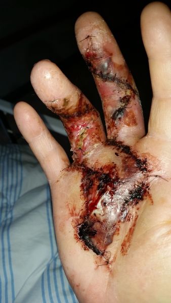 2017-04-08-0904_Sår efter operation i hånd_-