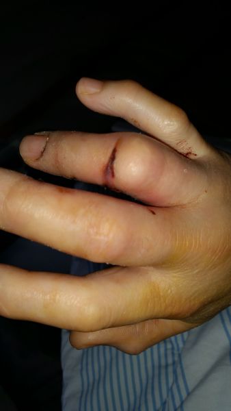 2017-04-08-0904_Sår efter operation i hånd_-_2