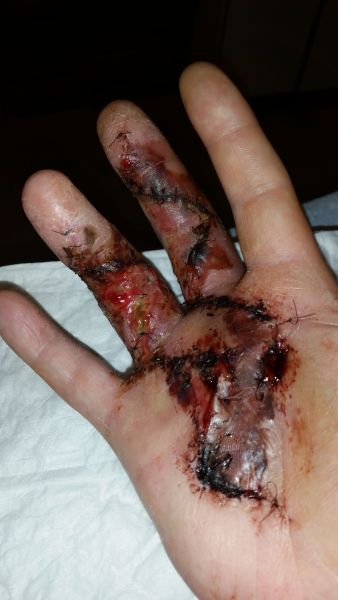 2017-04-08-1415_Sår efter operation i hånd_-