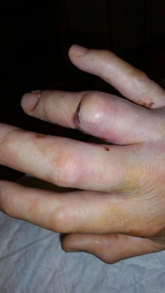 2017-04-08-1415_Sår efter operation i hånd_-_2