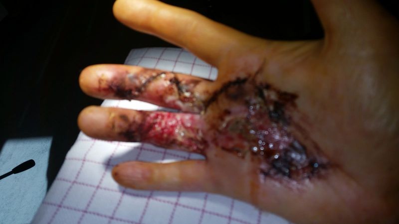 2017-04-10-0955_Sår efter operation i hånd_-