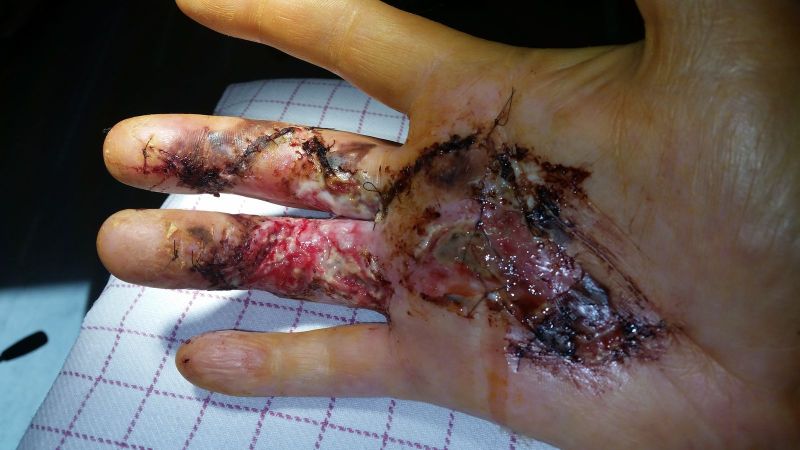 2017-04-10-0955_Sår efter operation i hånd_-_2
