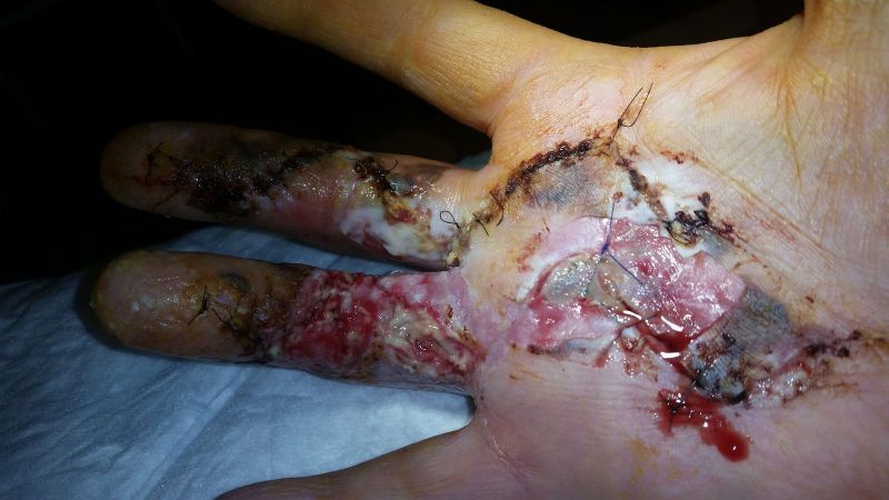 2017-04-10-1020_Sår efter operation i hånd_-