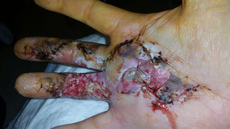 2017-04-10-1020_Sår efter operation i hånd_-_2