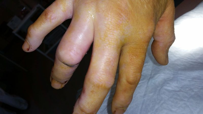 2017-04-10-1020_Sår efter operation i hånd_-_3