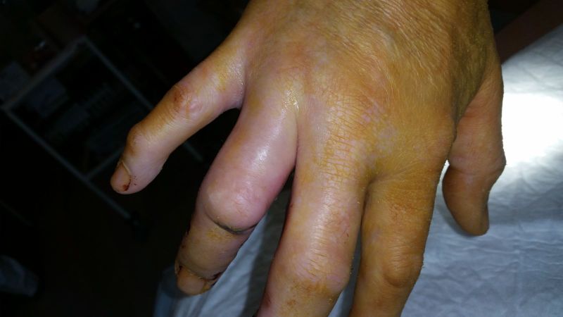 2017-04-10-1020_Sår efter operation i hånd_-_4