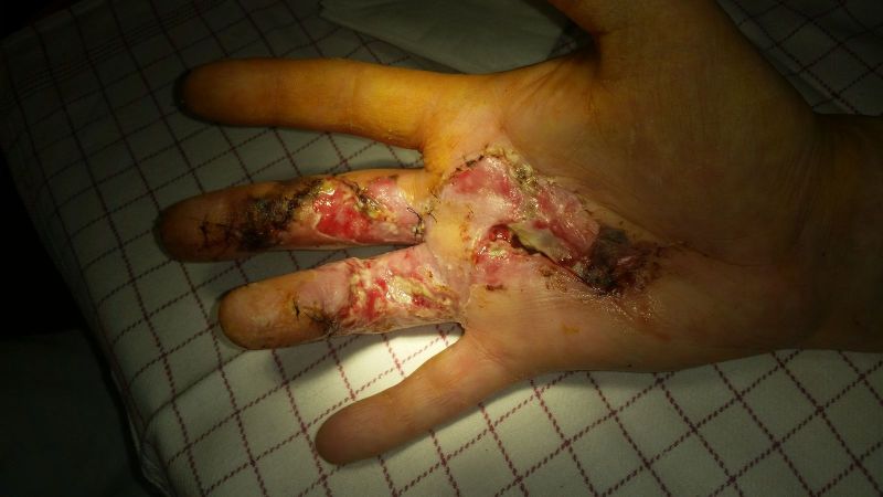 2017-04-11-1038_Sår efter operation i hånd_-_2