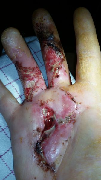 2017-04-12-0920_Sår efter operation i hånd_-