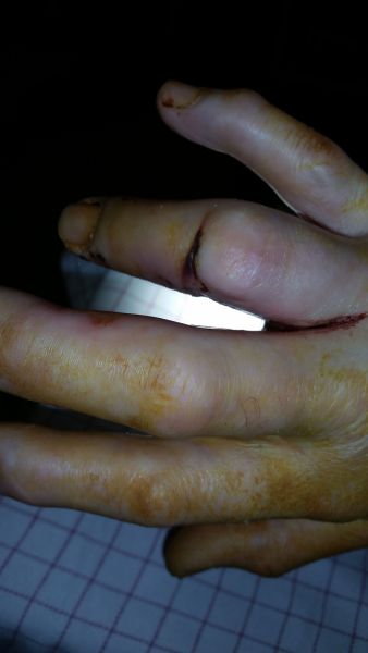 2017-04-12-0920_Sår efter operation i hånd_-_2