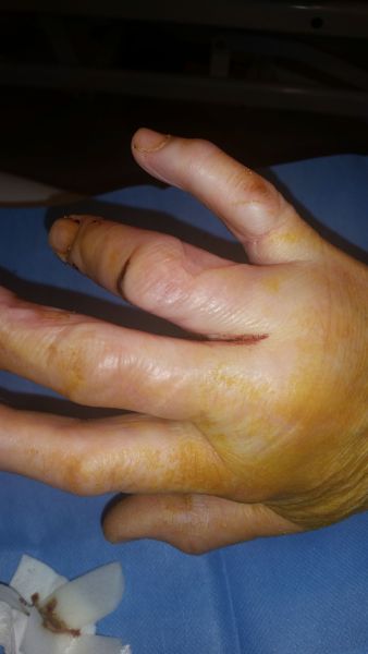 2017-04-16-1300_Sår efter operation i hånd_-_2