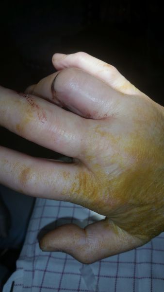 Sår efter operation i hånd