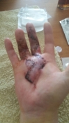 2017-04-04-0957_Sår efter operation i hånd_-