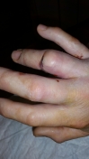 2017-04-08-1415_Sår efter operation i hånd_-_2