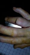 2017-04-12-0920_Sår efter operation i hånd_-_2