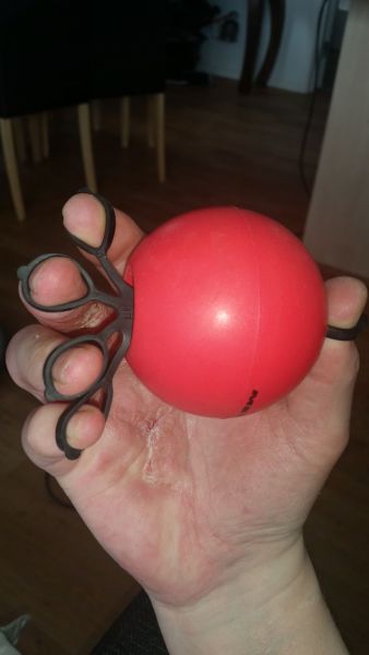 Sår efter opration i hånd