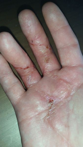 Sår efter opration i hånd