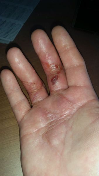 Sår efter opration i hånd