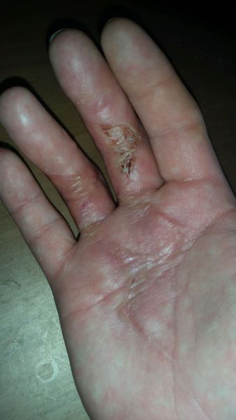 Sår efter operation i hånd