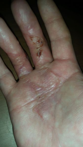 Sår efter operation i hånd