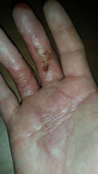 Sår efter operation i hånd