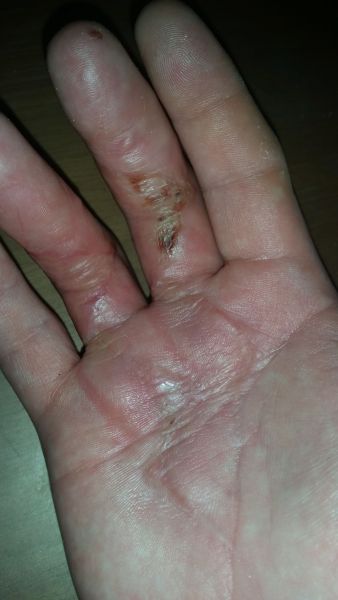 Sår efter operation i hånd