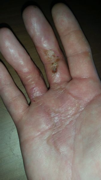 Sår efter operation i hånd
