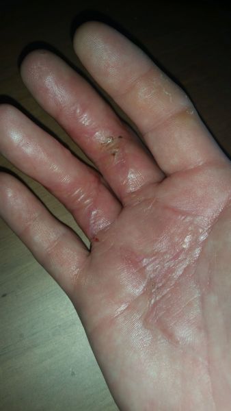 Sår efter operation i hånd