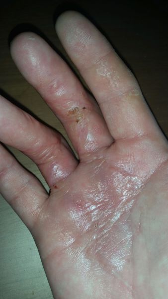 Sår efter operation i hånd