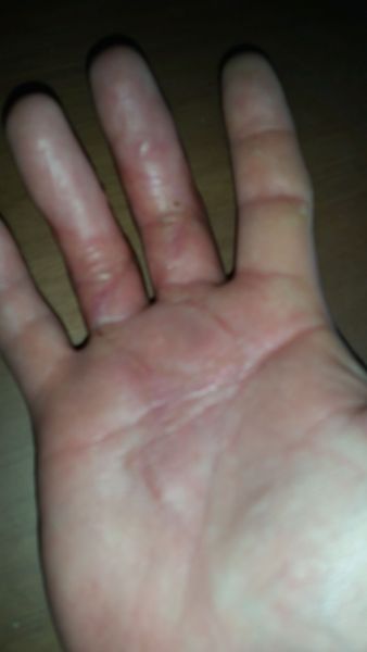Sår efter operation i hånd