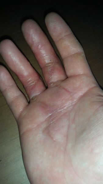 Sår efter operation i hånd
