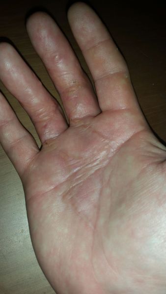 Sår efter operation i hånd