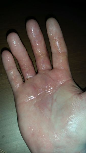 Sår efter operation i hånd