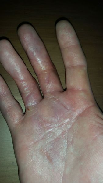 Sår efter operation i hånd