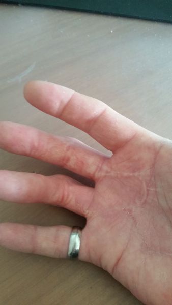 Sår efter operation i hånd