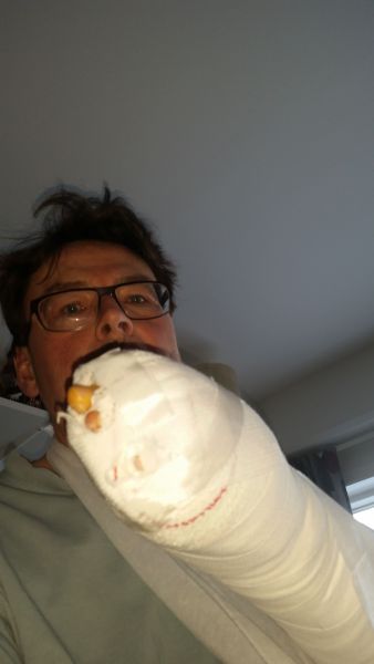 Dagen efter operation - med boksehandske