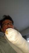 Dagen efter operation - med boksehandske