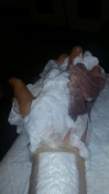 1. skifte af forbinding 1 uge efter operation