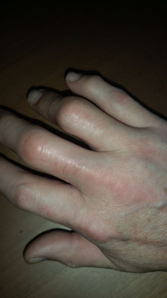 Sår efter operation i hånd