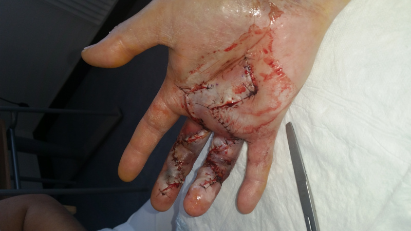 Stive fingre opereret 3 dage after operationen