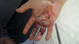 Stive fingre opereret 3 dage after operationen